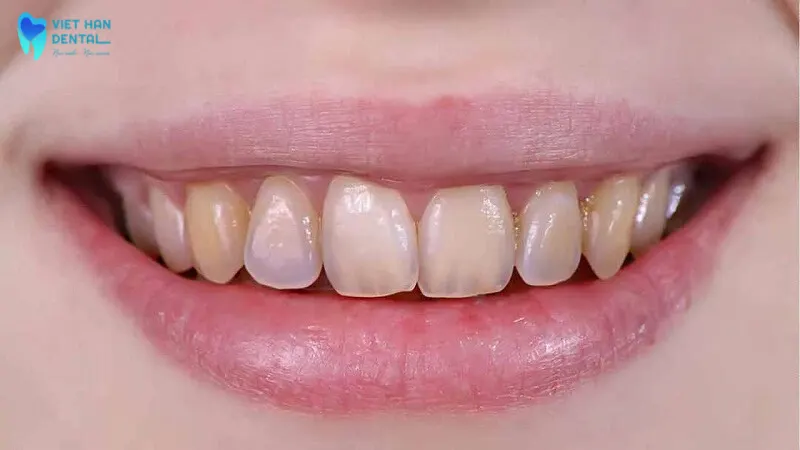 Răng khi bị chấn thương ở mức độ nặng có thể làm lộ ra phần ngà răng