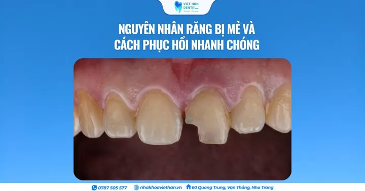 Nguyên nhân răng bị mẻ và cách phục hồi nhanh chóng