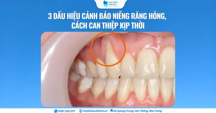 3 dấu hiệu cảnh báo niềng răng hỏng, cách can thiệp kịp thời