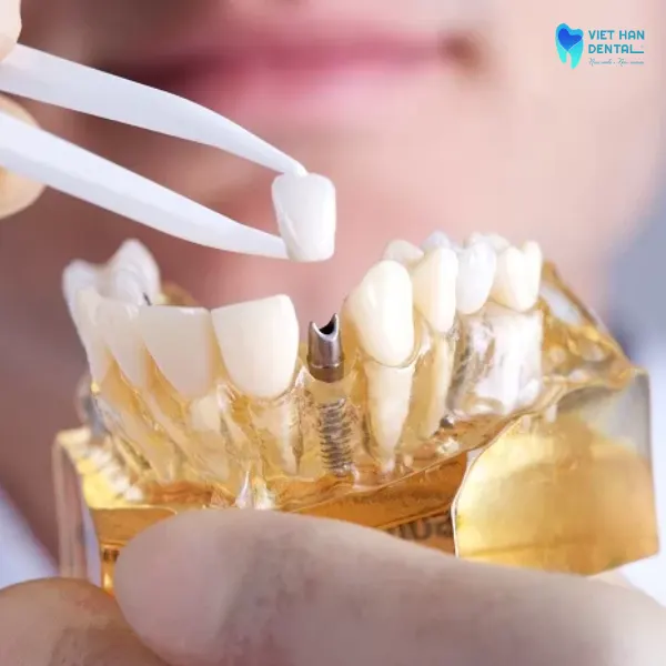 Chọn nha khoa trồng răng uy tín tại Nha Trang