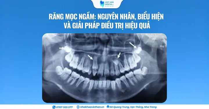 Răng mọc ngầm: Nguyên nhân, biểu hiện và giải pháp điều trị hiệu quả