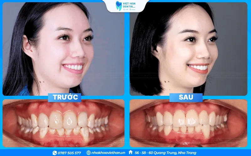 Lựa chọn địa chỉ nhoa uy tín tại Nha Trang để làm răng sứ an toàn, hiệu quả