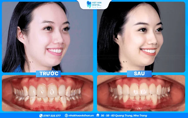 Lựa chọn địa chỉ nhoa uy tín tại Nha Trang để làm răng sứ an toàn, hiệu quả của Bác sĩ Lê Châu Hưng Thịnh