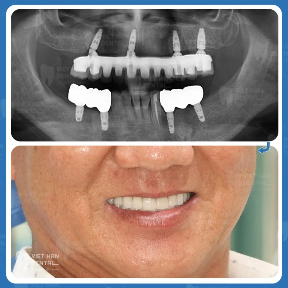 co-so-cay-ghep-implant-uy-tin-tai-Nha-Trang