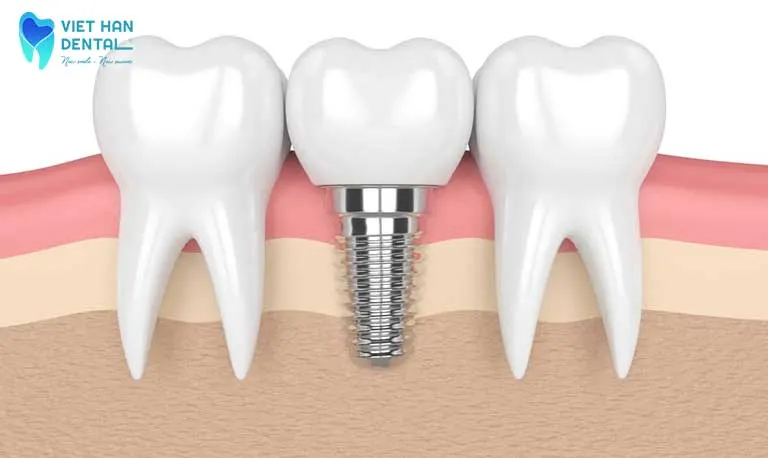 Trồng răng Implant