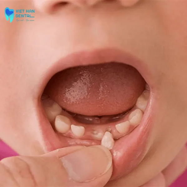 4Niềng răng cho con khi rụng răng sữa quá sớm hoặc quá muộn