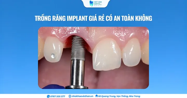 Trồng răng Implant giá rẻ có an toàn không