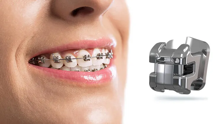 Mắc cài tự buộc