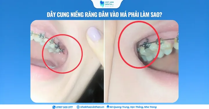 Dây cung niềng răng đâm vào má phải làm sao?