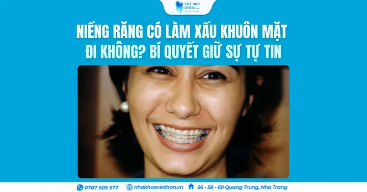 Niềng răng có làm xấu khuôn mặt đi không? Bí quyết giữ sự tự tin