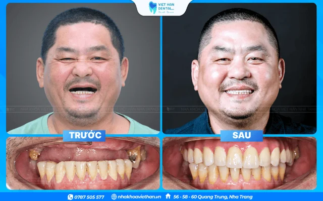 Khách hàng trồng răng Implant toàn hàm do bác sĩ Khổng Văn Quân thực hiện của Bác sĩ Khổng Văn Quân