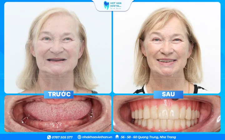 Chị Irina trước và sau trồng răng Implant toàn hàm