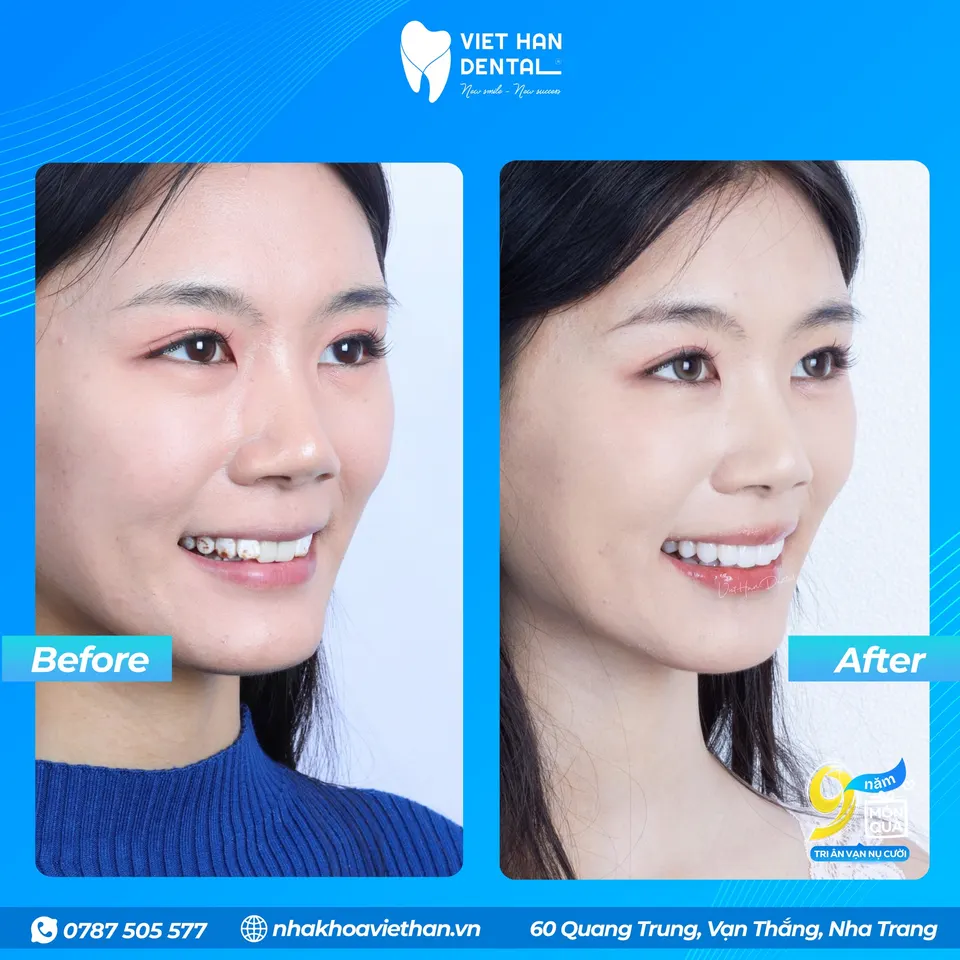 My Anh before and after getting cosmetic dental veneers.