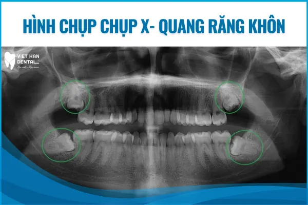 Thăm khám và chụp x- quang