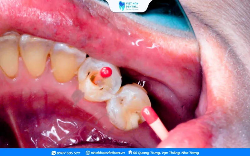 Lấy tủy là bước loại bỏ phần tủy răng bị viêm nhiễm hoặc hư hỏng