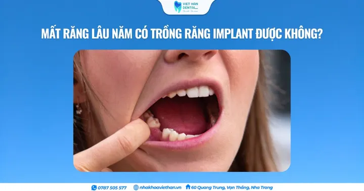 Mất răng lâu năm có trồng răng Implant được không?