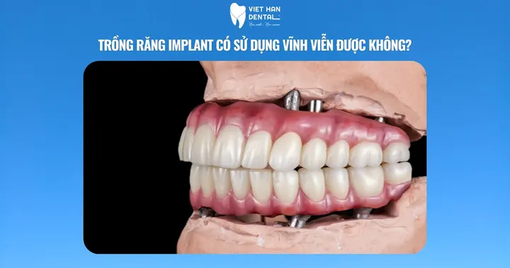 Trồng răng Implant có sử dụng vĩnh viễn được không?