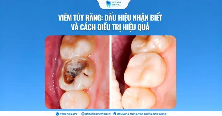 Viêm tủy răng: Dấu hiệu nhận biết và cách điều trị hiệu quả
