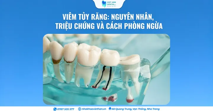 Viêm tủy răng: Nguyên nhân, triệu chứng và cách phòng ngừa