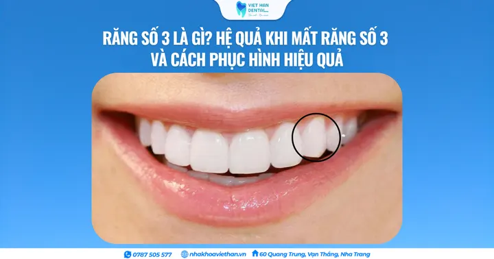 Răng số 3 là gì? Hệ quả khi mất răng số 3 và cách phục hình hiệu quả