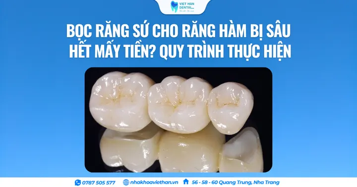 Bọc răng sứ cho răng hàm bị sâu hết mấy tiền? Quy trình thực hiện