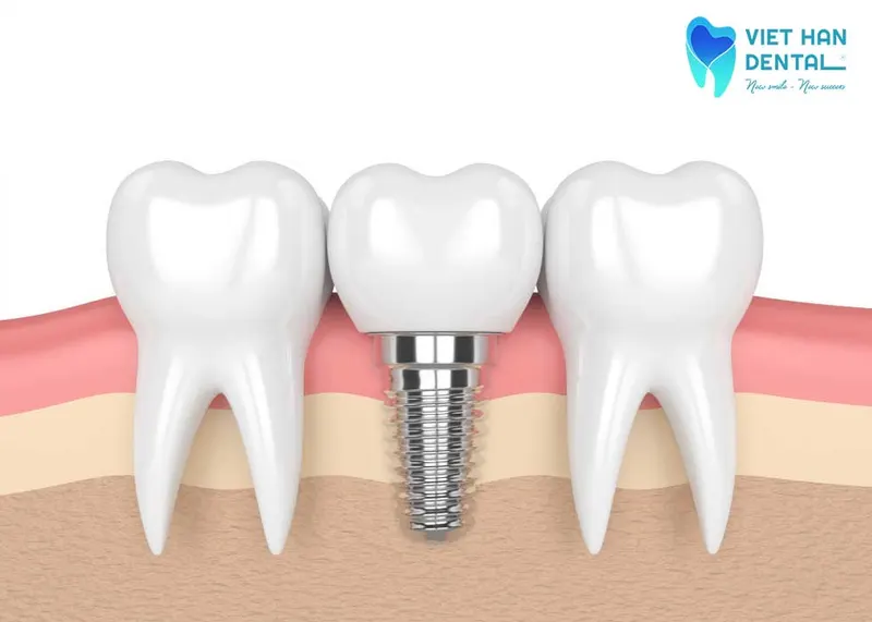 Trồng răng Implant để thay thế cho chân răng đã mất
