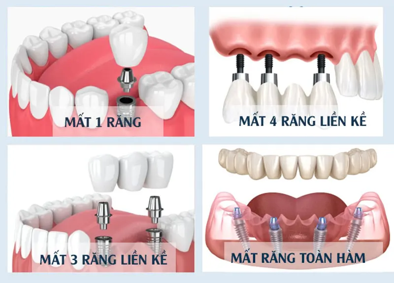 Các trường hợp nên trồng răng Implant