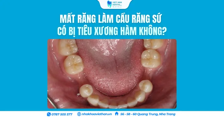 Mất răng làm cầu răng sứ có bị tiêu xương hàm không?