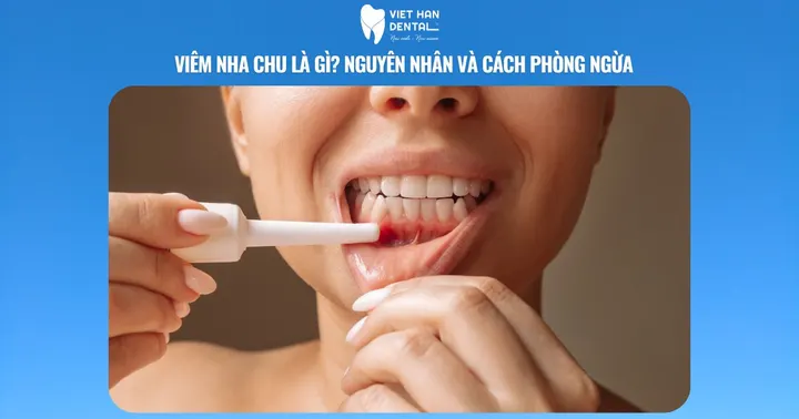 Viêm nha chu là gì? Nguyên nhân và cách phòng ngừa
