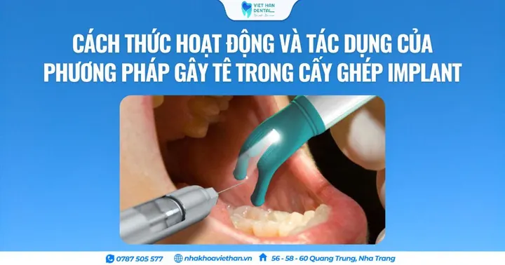 Cách thức hoạt động và tác dụng của phương pháp gây tê trong cấy ghép Implant