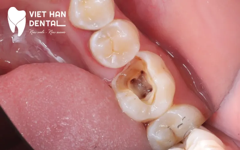 Sâu răng chính là một trong những nguyên nhân hàng đầu dẫn đến mất răng 