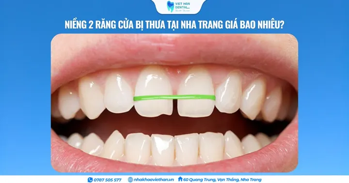Niềng 2 răng cửa bị thưa tại Nha Trang giá bao nhiêu?
