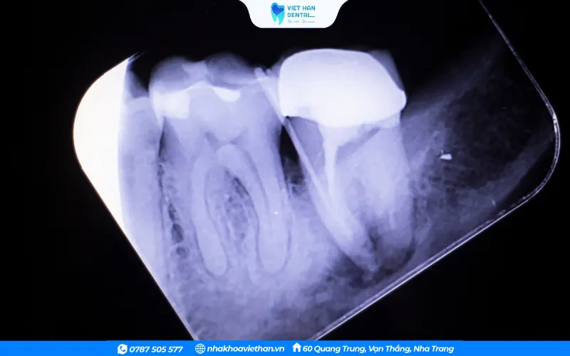 Viêm tủy có thể lan sang các mô xung quanh