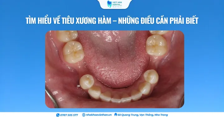 Tìm hiểu về tiêu xương hàm – Những điều cần phải biết