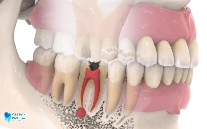 4Vì sao bạn cần phải điều trị tuỷ?&nbsp;