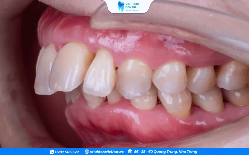 Tình trạng 4 răng cửa bị hô