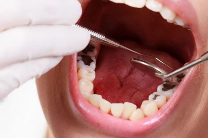 Trám răng lấy tủy có đau không?