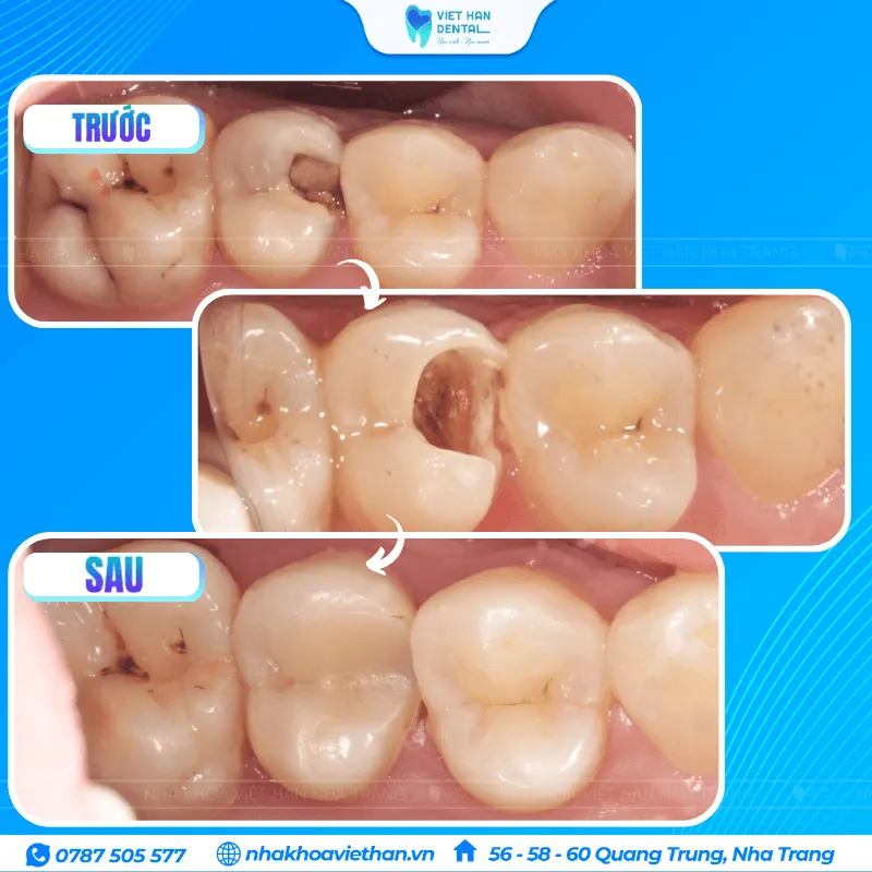 Trám răng hàm bị sâu nặng