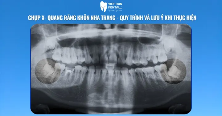Chụp X- quang răng khôn Nha Trang – quy trình và lưu ý khi thực hiện