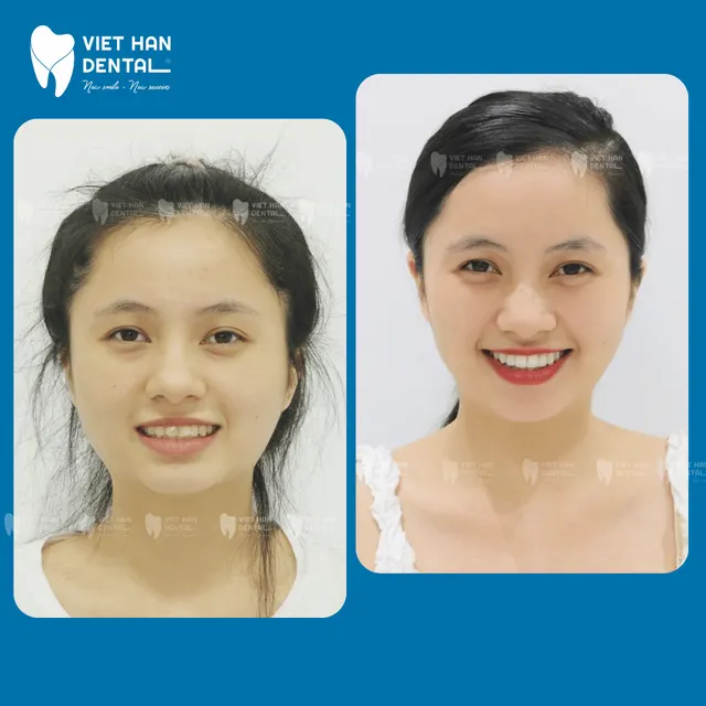 Hình ảnh khách hàng trước - sau khi niềng răng tại Nha khoa Việt Hàn Nha Trang