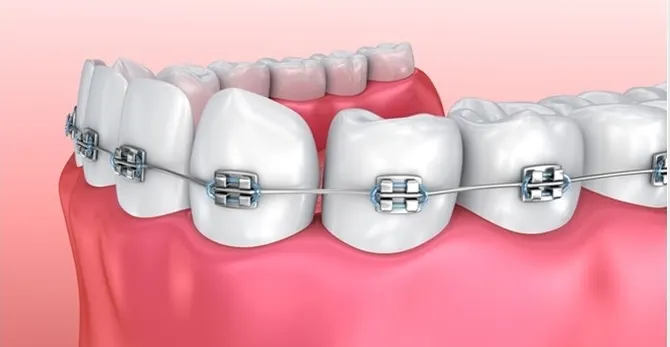 niềng răng mắc cài kim loại