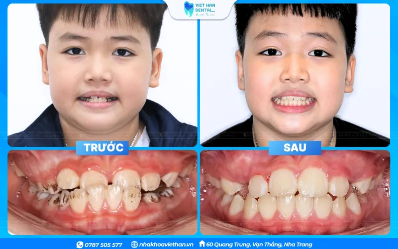 Sau khi kết thúc chỉnh nha phụ huynh nên đưa bé đi khám định kỳ 6 tháng/ lần