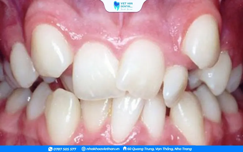 Nhổ răng lòi xỉ là không cần thiết