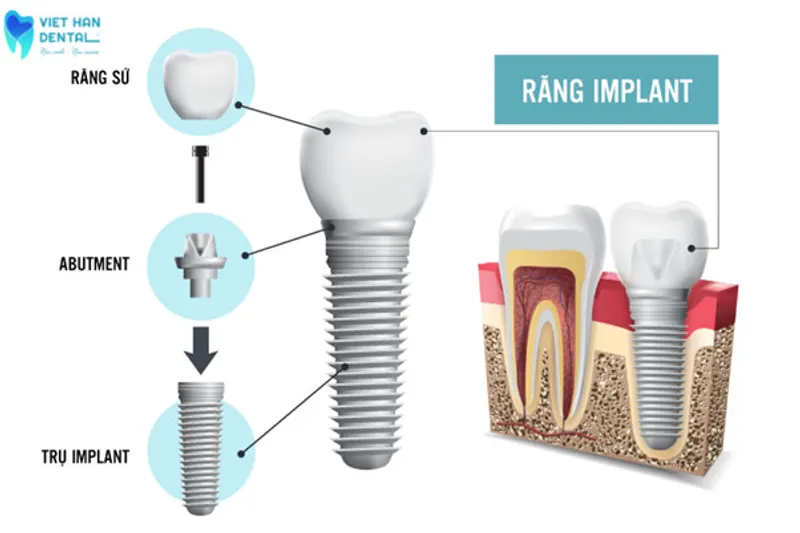 Cấu tạo của một Implant