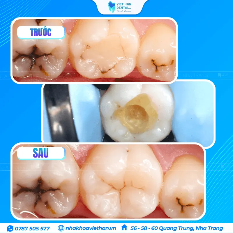 Trám răng hàm số 6 bị sâu