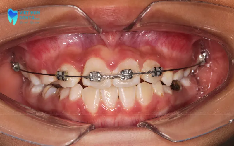 6-12 tuổi là thời điểm "vàng" để niềng răng cho trẻ