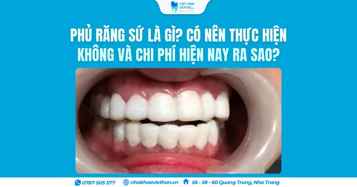Phủ răng sứ là gì? Có nên thực hiện không và chi phí hiện nay ra sao?