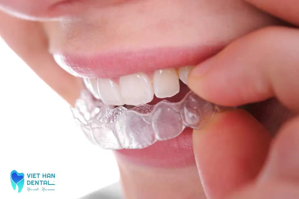 Tẩy trắng răng bằng máng tẩy tại nhà 