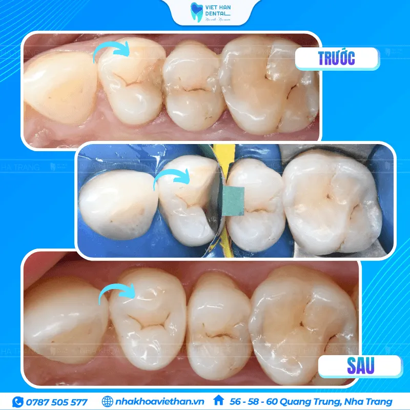 Chị Clara trước và sau khi trám răng
