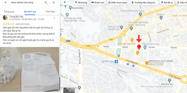 Khách hàng review về dịch vị nhổ răng khôn tại Nha khoa Quốc tế Daisy Nha Trang